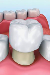 Dental Crowns | Brown Family Dentistry | Fort Worth Texas
