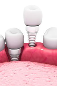 Dental Implants | Brown Family Dentistry | Fort Worth Texas