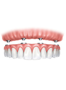 dr-kent-brown-dentist-fort-worth-texas-implant-supported-dentures