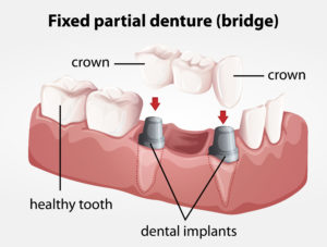 dr-brown-fixed partial denture bridge