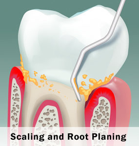 brown-family-dentistry-ft-worth-tx-scaling-root-planing